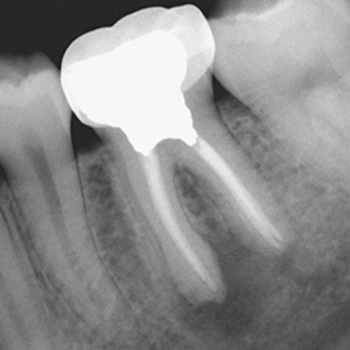Endodontic <br>Treatment
